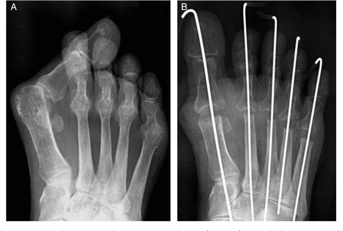 Hesi case study rheumatoid arthritis with joint arthroplasty