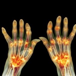 Hesi case study rheumatoid arthritis with joint arthroplasty