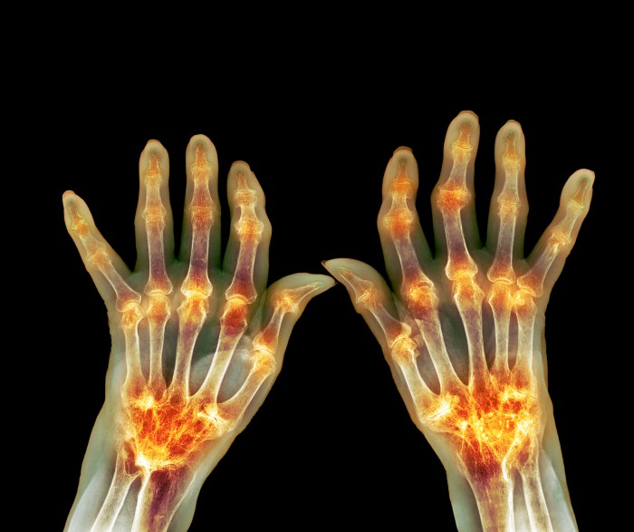 Hesi case study rheumatoid arthritis with joint arthroplasty